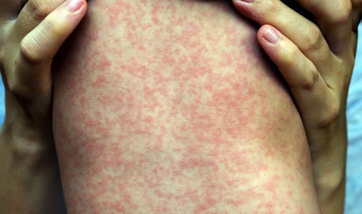 Epidemija ospica u SAD-u